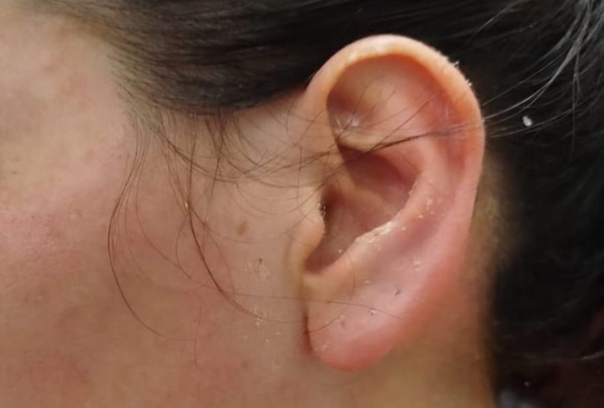 Mulher sofre ataque com água fervendo em Foz; agressor é preso