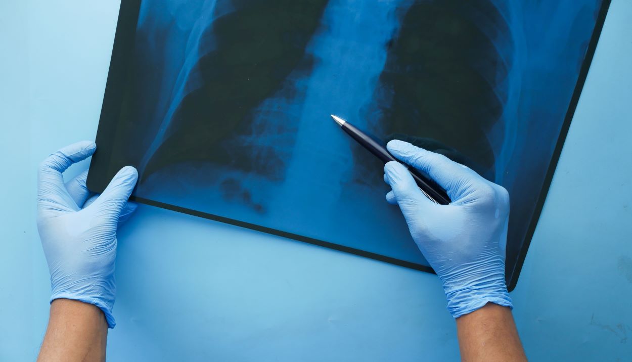 Câncer de pulmão pode ter 90% de chance de cura; saiba quem deve fazer exame